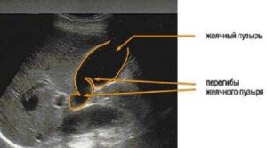 Загиб желчного пузыря как выглядит фото
