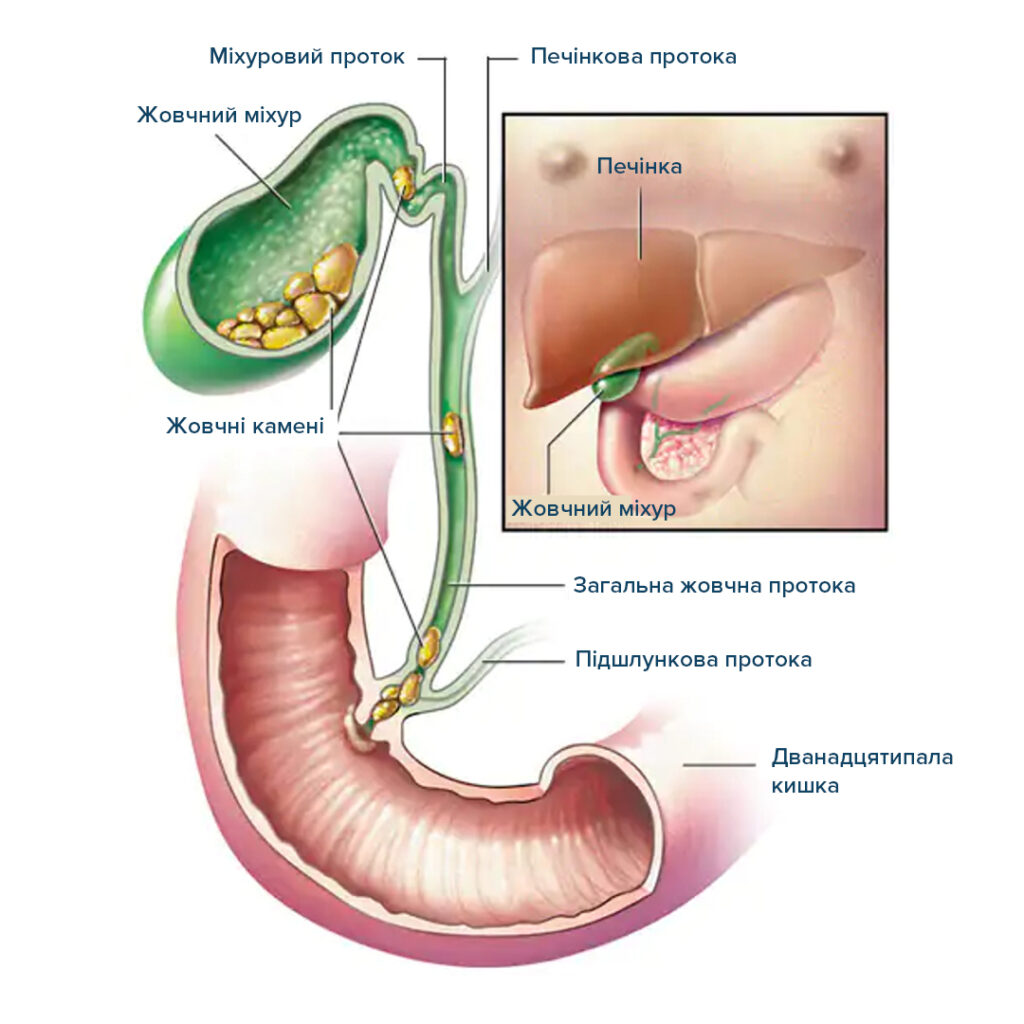 Холедохолітіаз